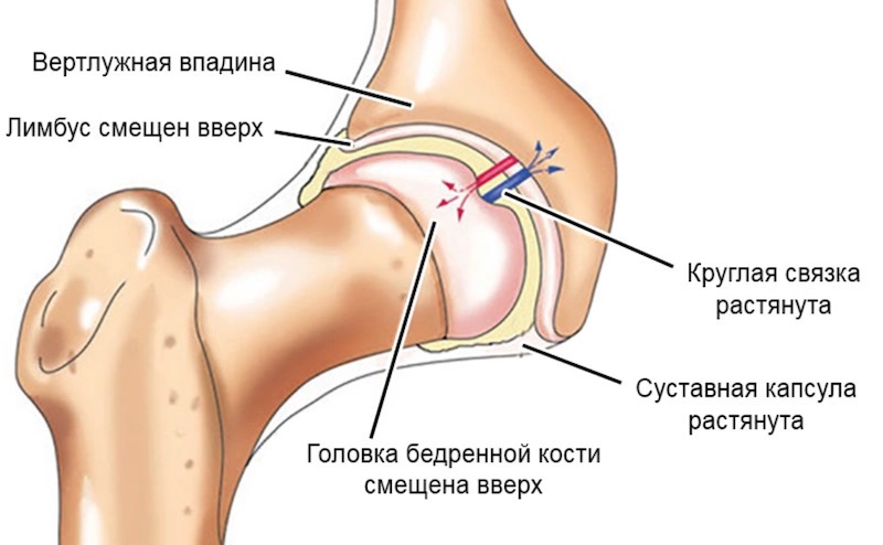 Боль в тазобедренном суставе у детей: причины, диагностика и лечение