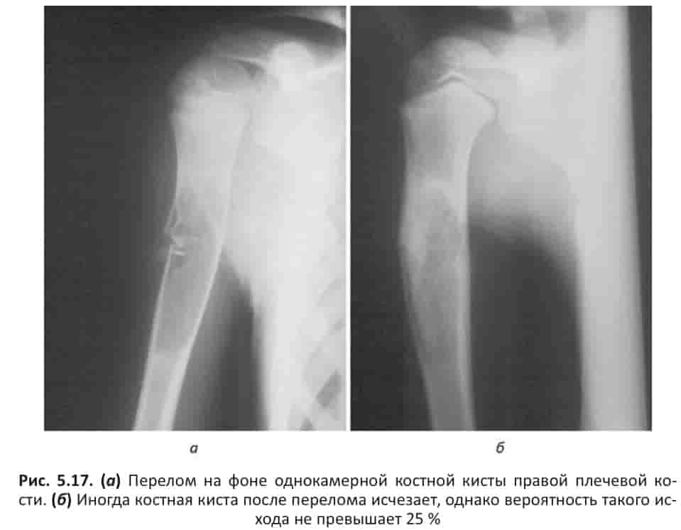 Патологический перелом плечевой кости