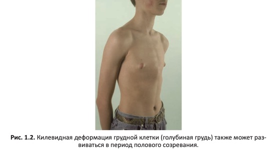Килевидная деформация грудной клетки (голубиная грудь)