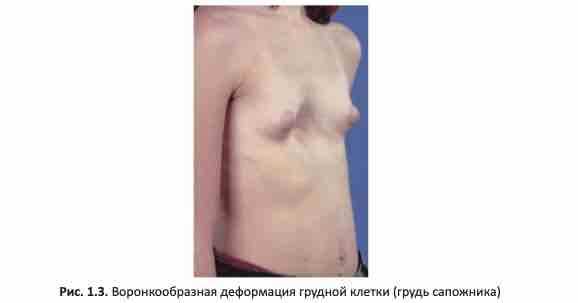 Воронкообразная деформация грудной клетки