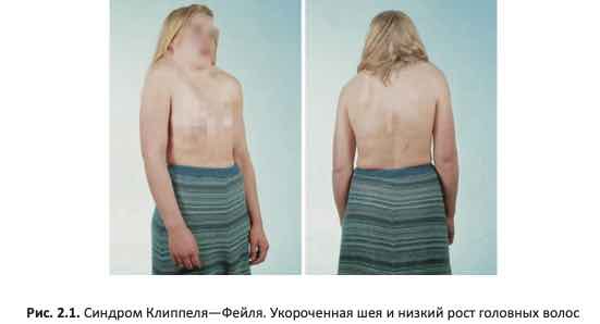 Синдром Клиппеля—Фейля