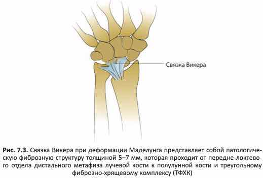 Связка Викера при деформации Маделунга