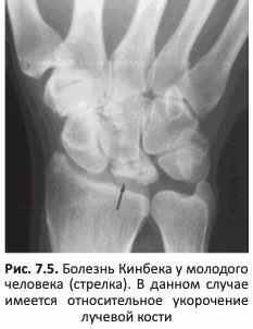 Болезнь Кинбека у молодого человека (стрелка)