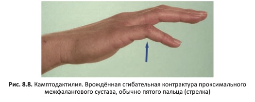 камптодактилия