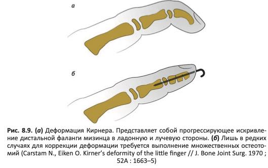 Деформация Кирнера