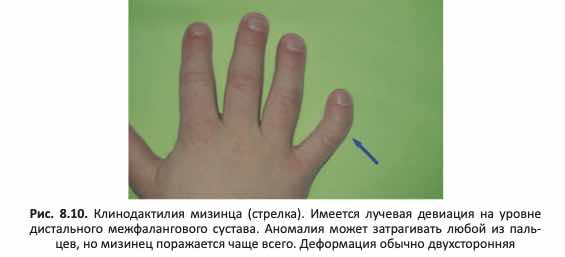 Клинодактилия мизинца