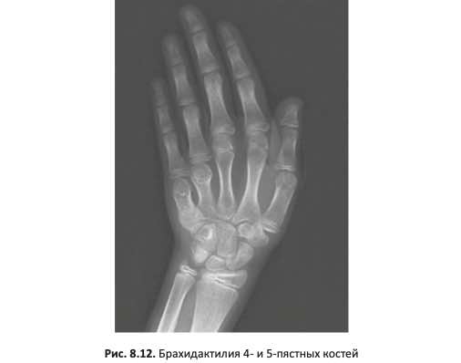 Брахидактилия 4- и 5-пястных костей