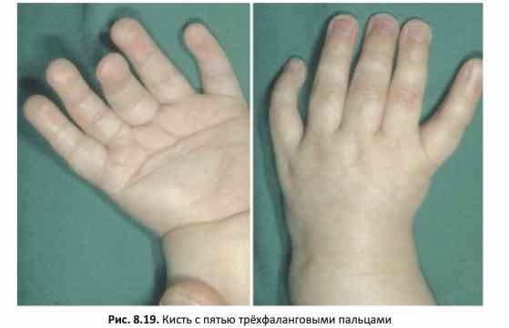 Кисть с пятью трёхфаланговыми пальцами