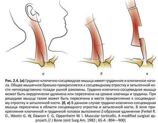 Операция при мышечной кривошее
