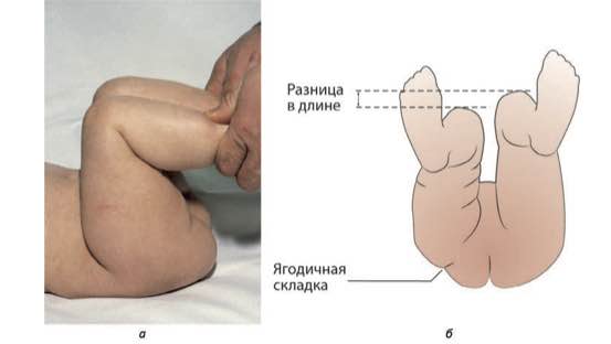 Разницу в длине бёдер