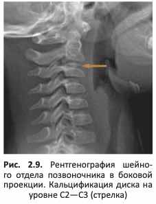 Кальцификация диска