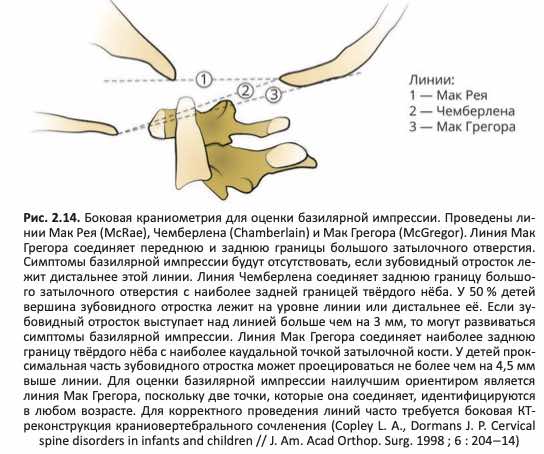 Базилярная импрессия