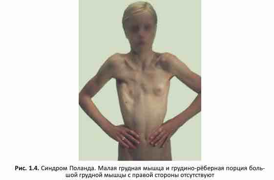 Синдром Поланда