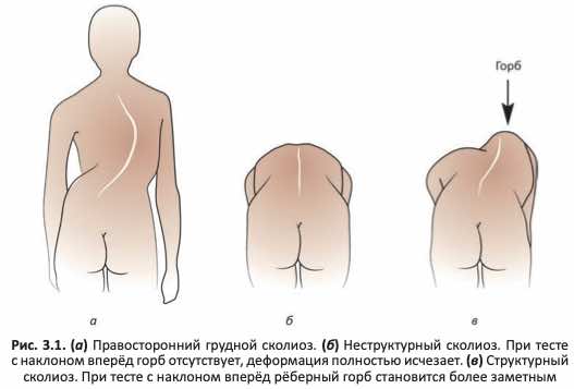 При структурном сколиозе деформация во время теста с наклоном вперёд сохраняется
