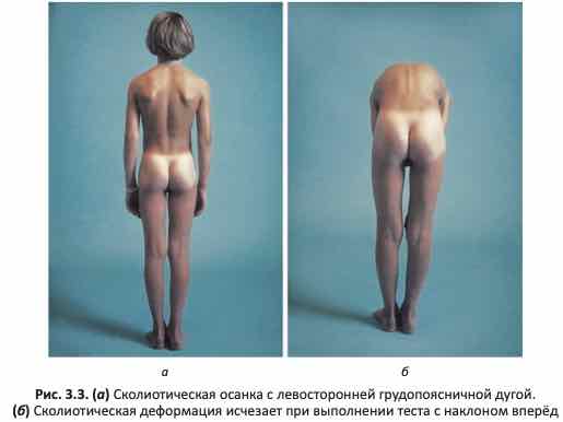 Сколиотическая осанка