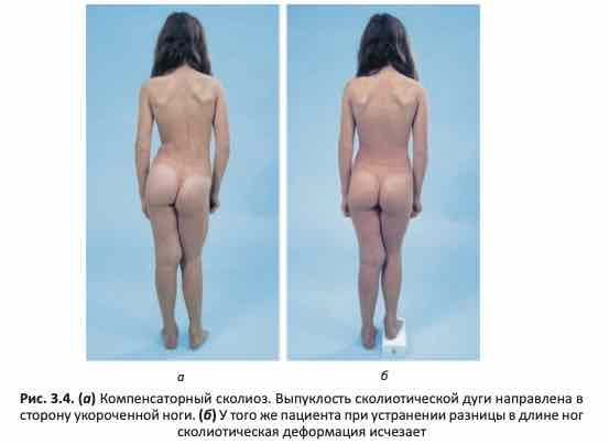 Компенсаторный сколиоз