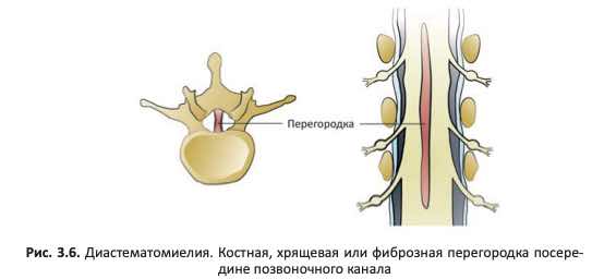 диастематомиелия