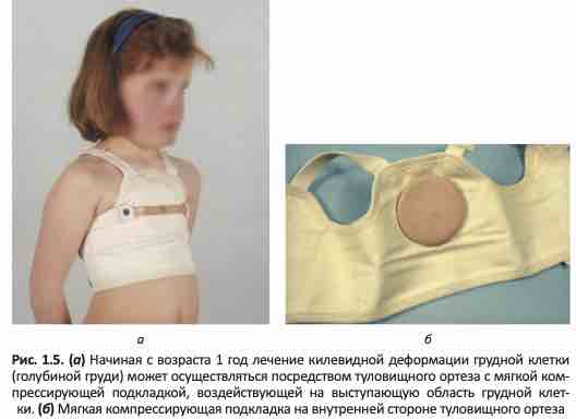 лечение килевидной деформации грудной клетки