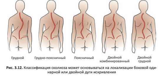 классификации сколиоза