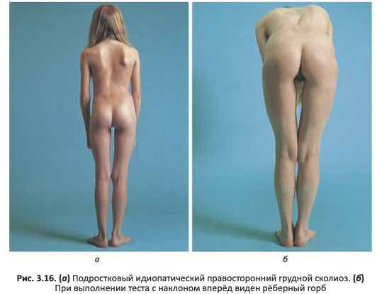 Подростковый идиопатический сколиоз