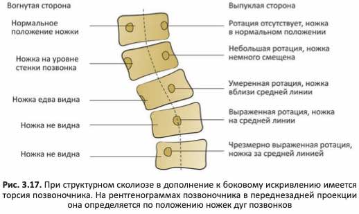 Торсия позвонков