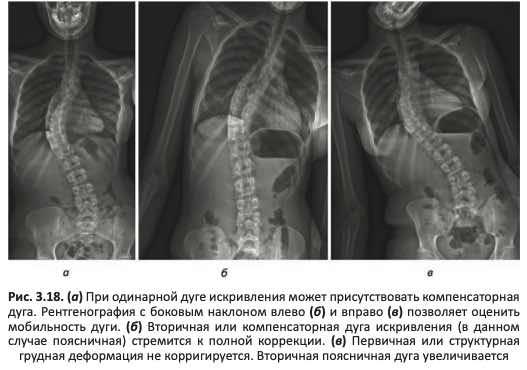 Компенсаторная дуга при сколиозе