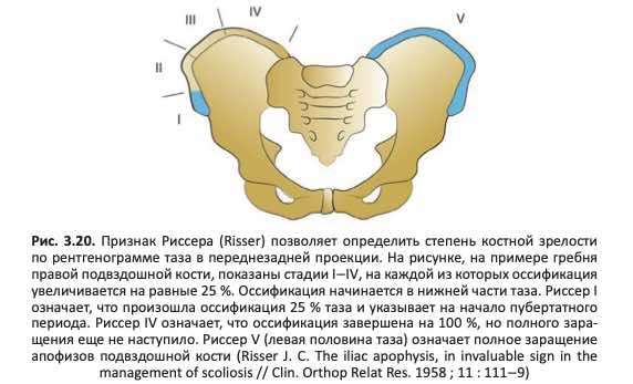 Признак Риссера