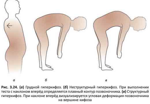 Грудной гиперкифоз