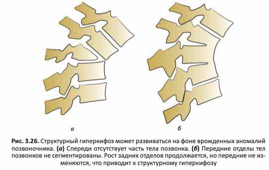 Врождённый гиперкифоз