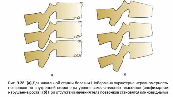 Начальная стадия болезни Шойермана