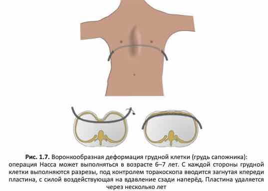операция Насса