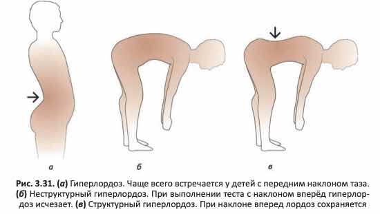 Гиперлордоз