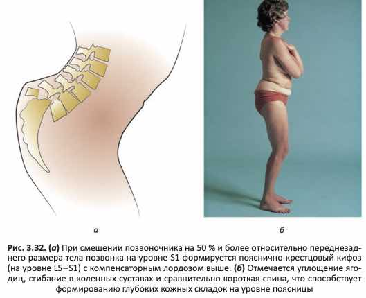Спондилолистез
