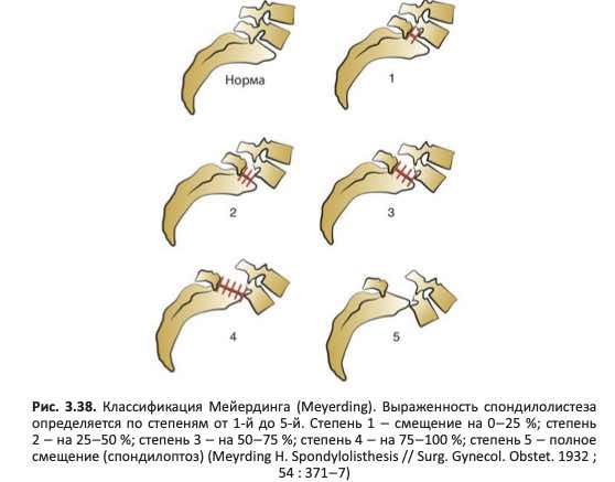 Классификация Мейердинга (Meyerding)