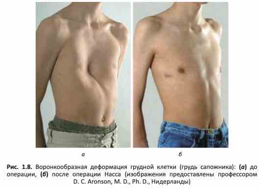 Воронкообразная деформация грудной клетки (грудь сапожника) операция