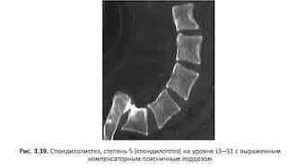 Спондилолистез