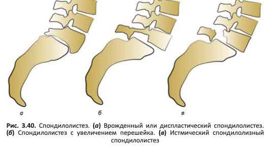 Спондилолистез. (а) Врожденный или диспластический спондилолистез.