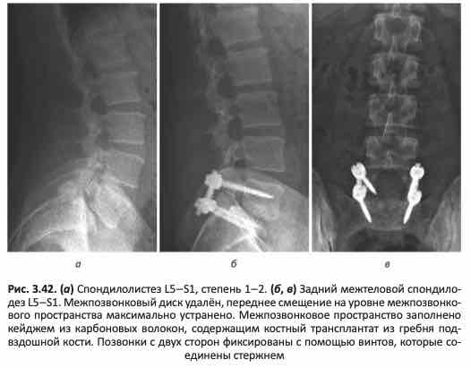 Задний межтеловой спондилодез L5—S1