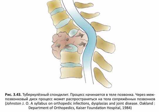 туберкулёзный спондилит