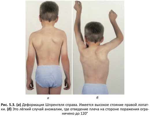 Деформация Шпренгеля справа
