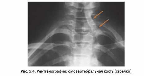 Рентгенография: омовертебральная кость