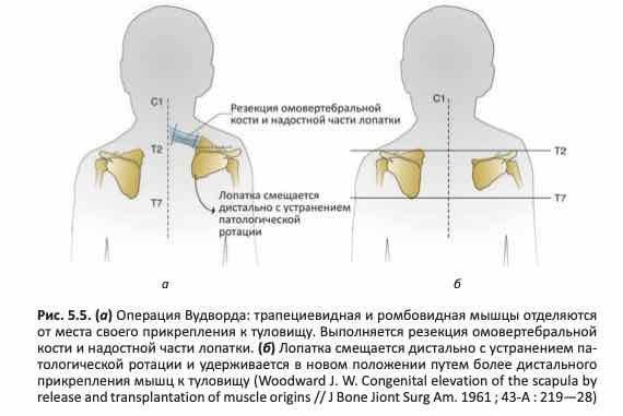 Операция Вудворда