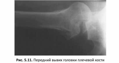 Передний вывих головки плечевой кости