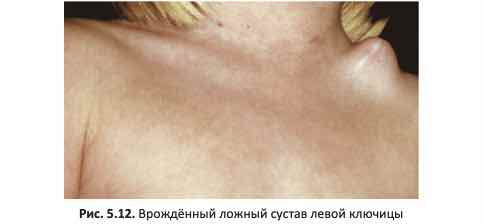 Врождённый ложный сустав левой ключицы