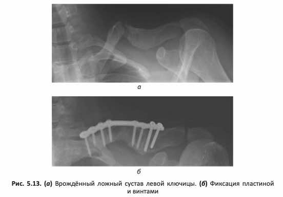 Врождённый ложный сустав левой ключицы