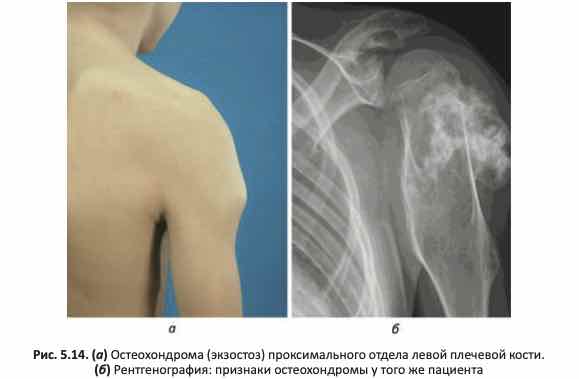 Остеохондрома (экзостоз) проксимального отдела левой плечевой кости