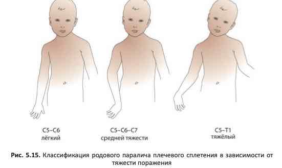 Классификация родового паралича плечевого сплетения в зависимости от тяжести поражения