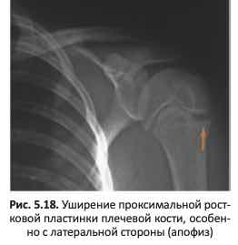 Уширение проксимальной рост- ковой пластинки плечевой кости