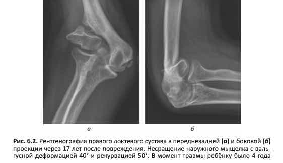 Рентгенография правого локтевого сустава в переднезадней (а) и боковой (б) проекции через 17 лет после повреждения