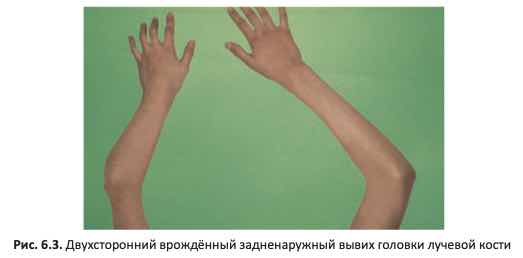 Двухсторонний врождённый задненаружный вывих головки лучевой кости